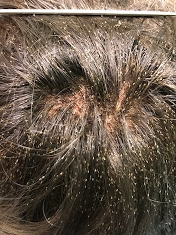 The Coming Plagues: Head Lice
